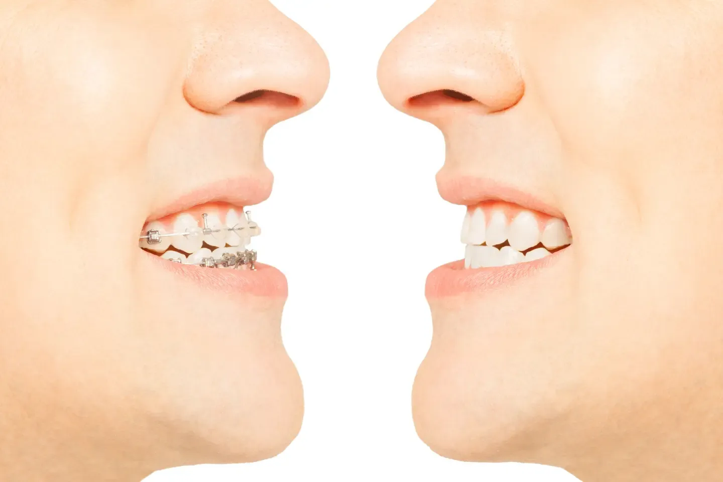 Orthodontist explaining overbite, underbite, and crossbite using dental models