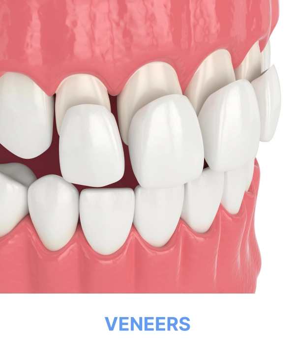 Veneers