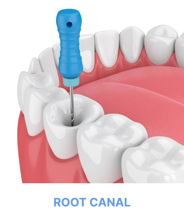 Root Canal