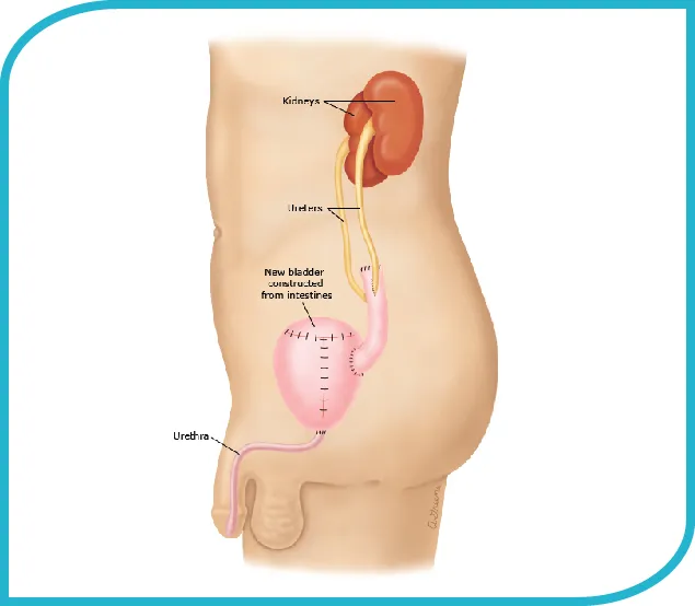 Neobladder/Ileal Conduit