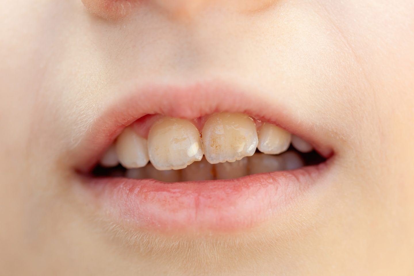 Tooth icon with a visible white patch symbolizing enamel demineralization.