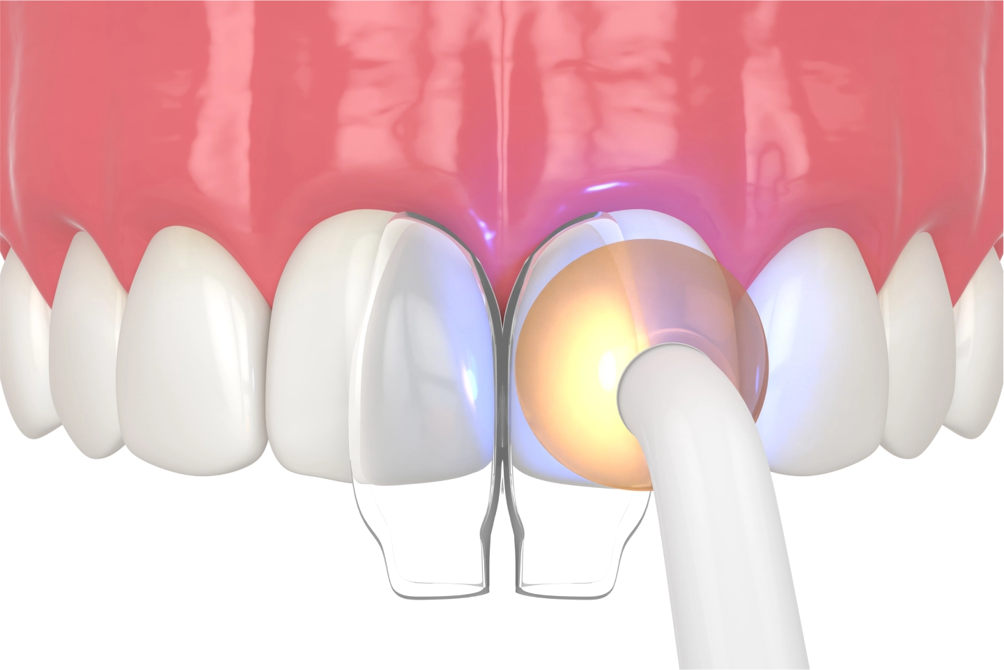 Composite Bonding