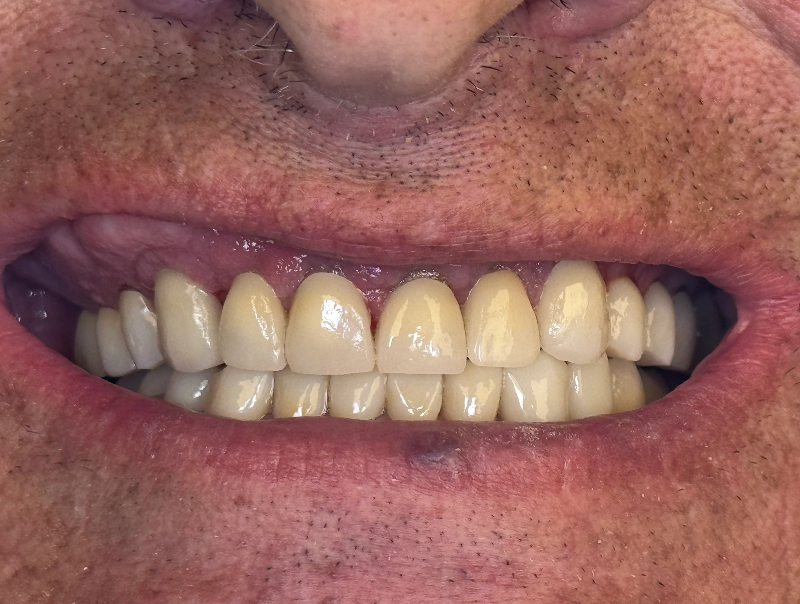 After Full Mouth Rehabilitation