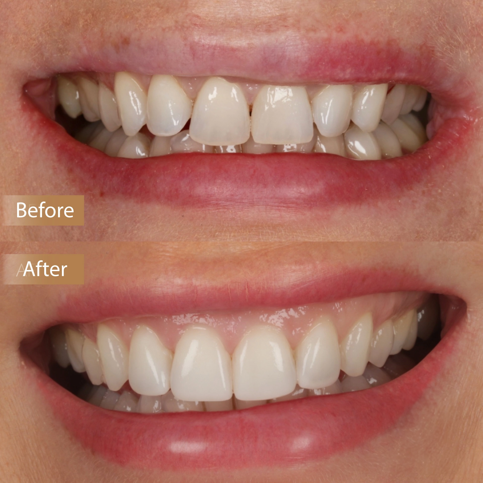 Teeth Straightening & Composite