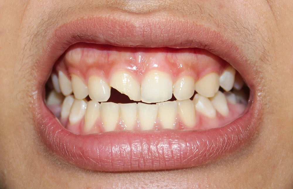 Chipped, Cracked, or Misshapen Teeth