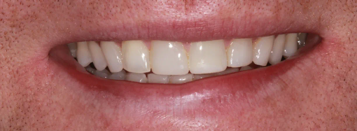 Composite Bonding