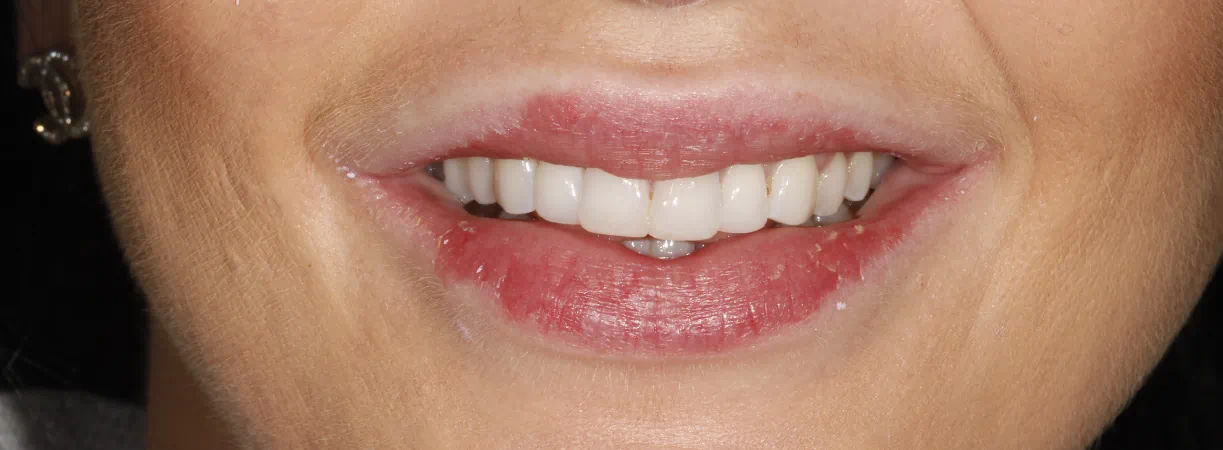 Inman Aligner