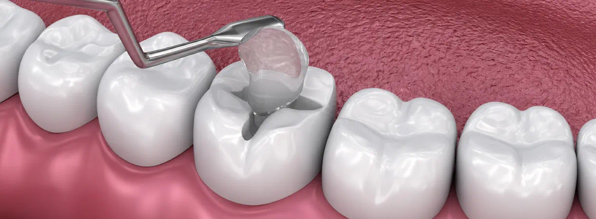 Dental Fillings