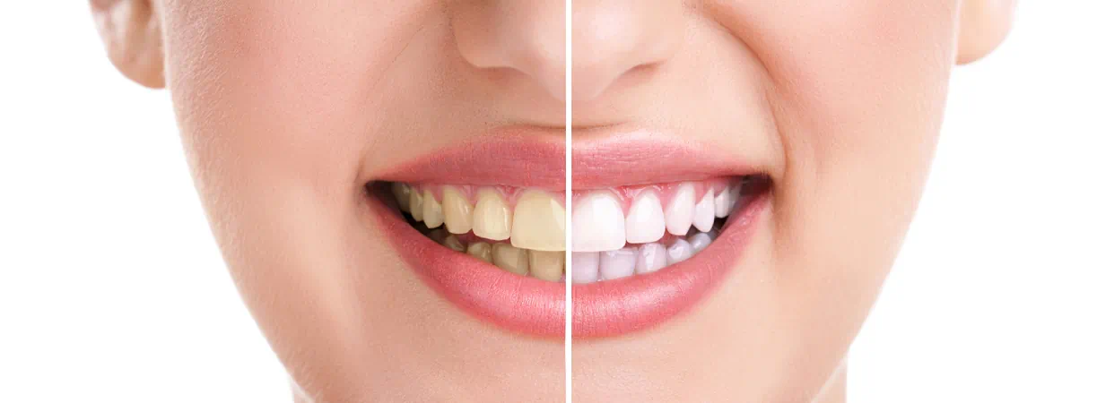 Teeth Whitening