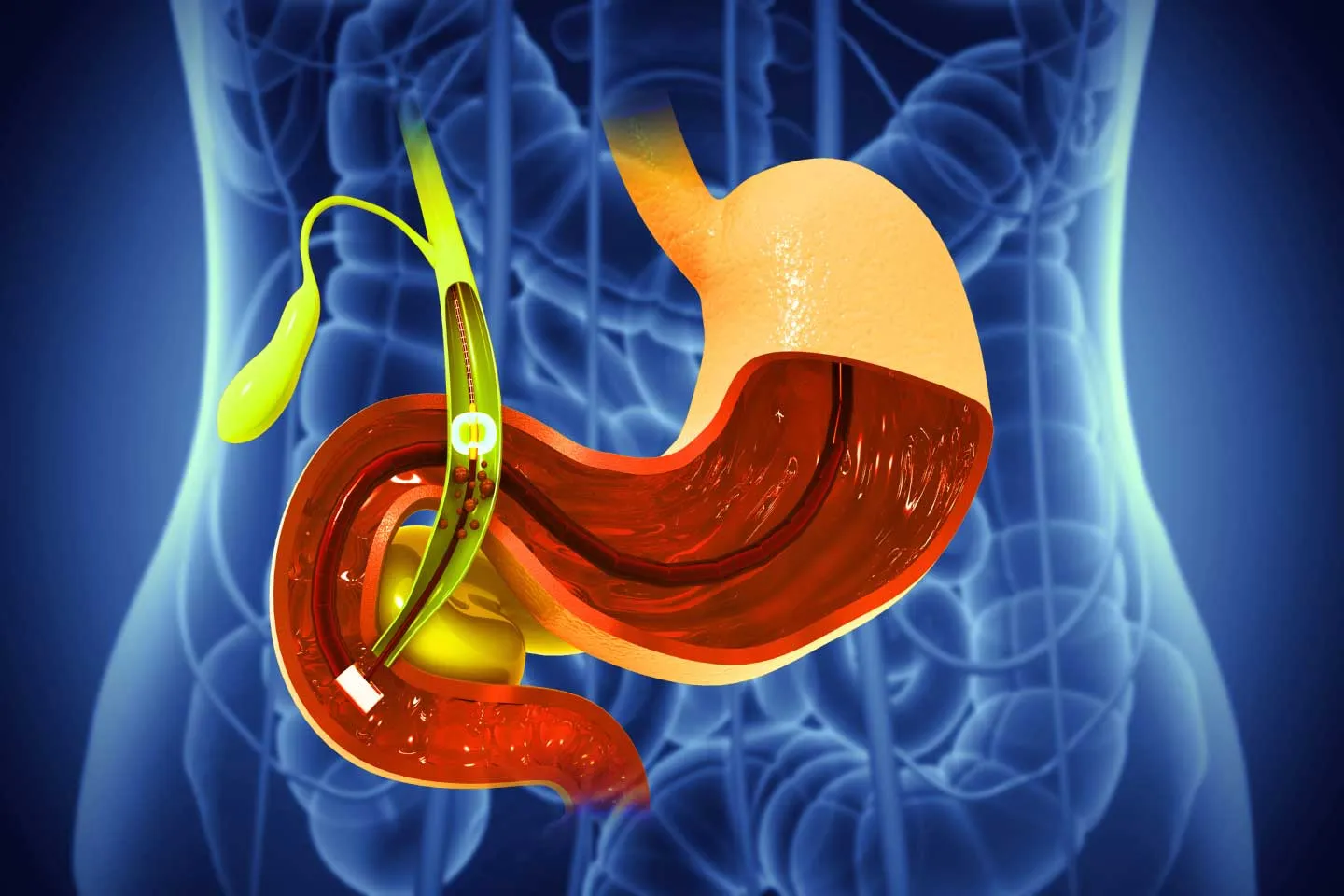 Gall Bladder and Biliary Surgery