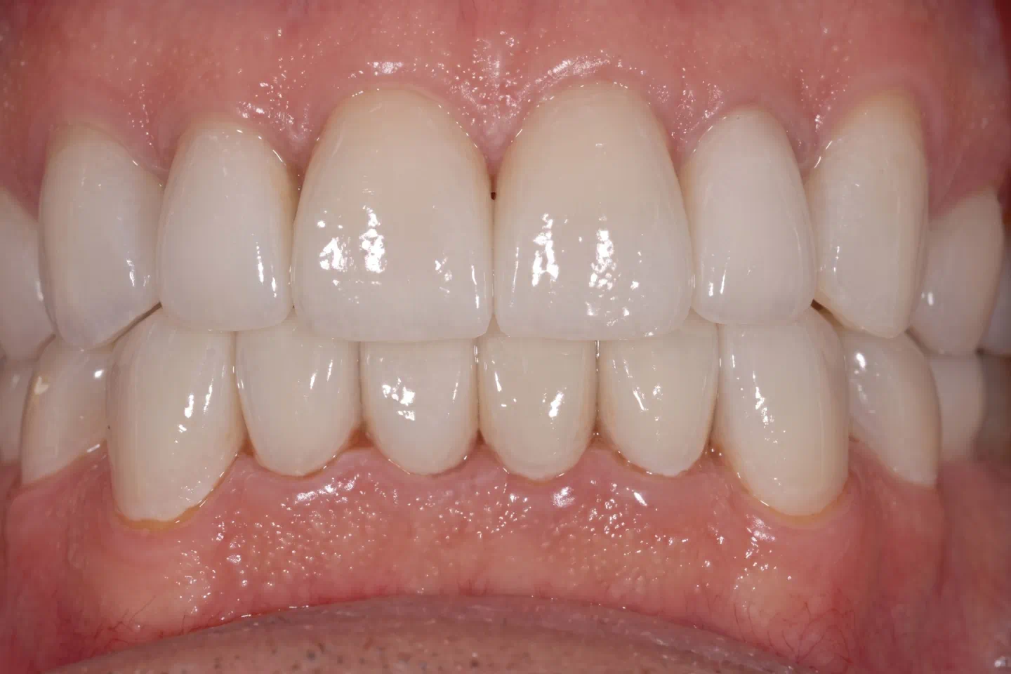 Bright smile after custom dental veneers