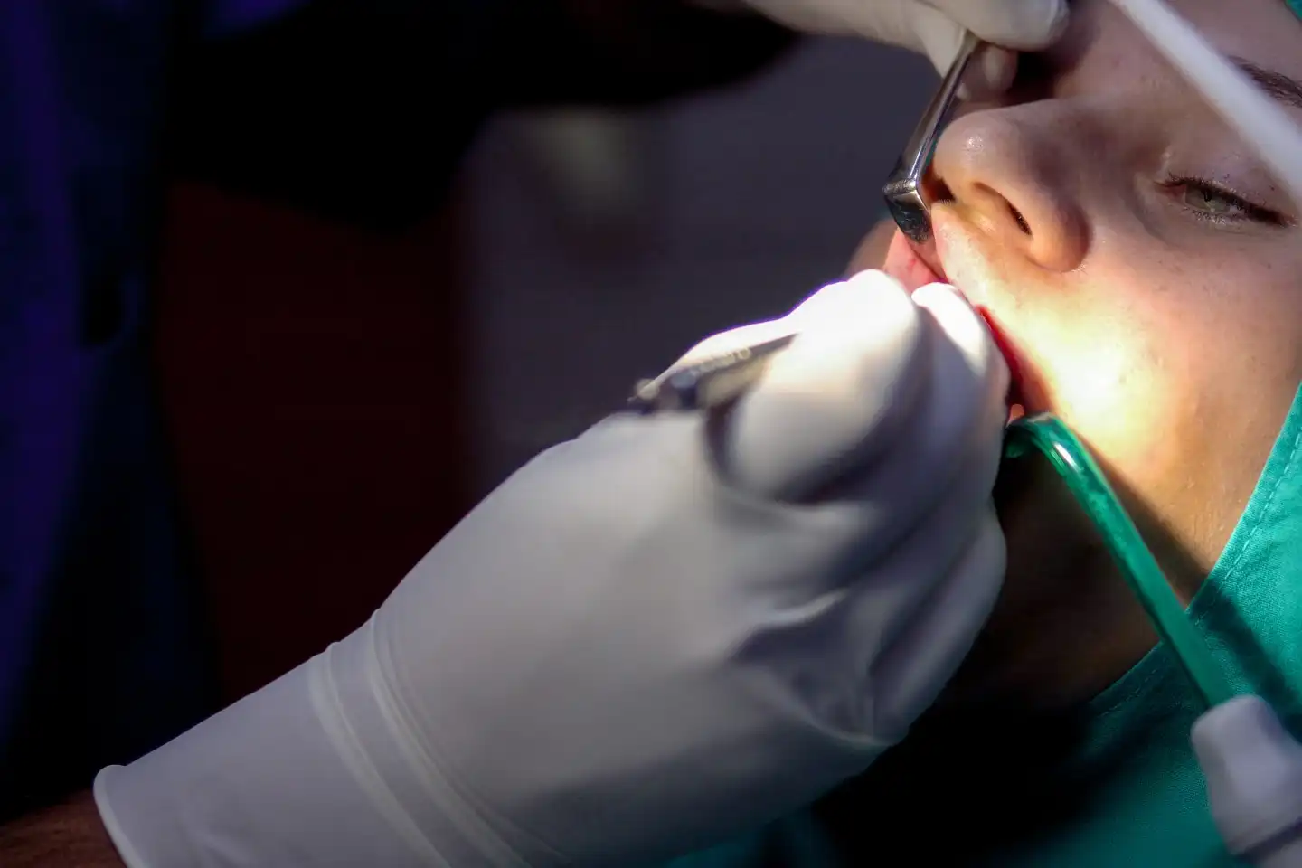 What to Eat After Oral Surgery with Stitches?