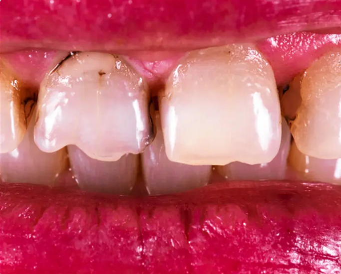 Damaged teeth before dental crown treatment
