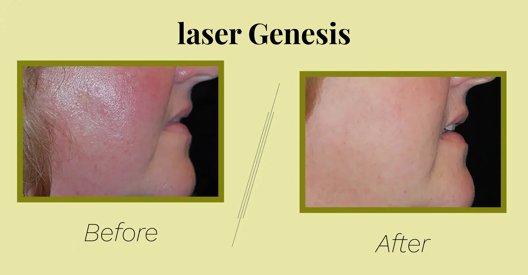 Photo Courtesy of Rick Green, MD for baseline laser genesis