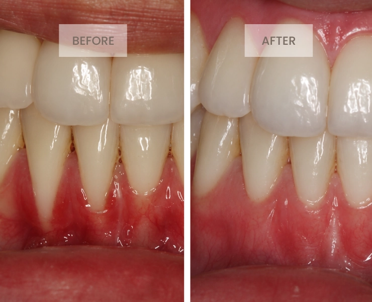 Before After 3