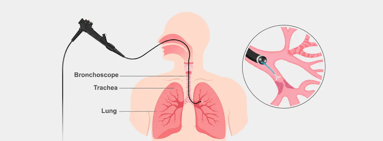 Bronchial Endoscopy