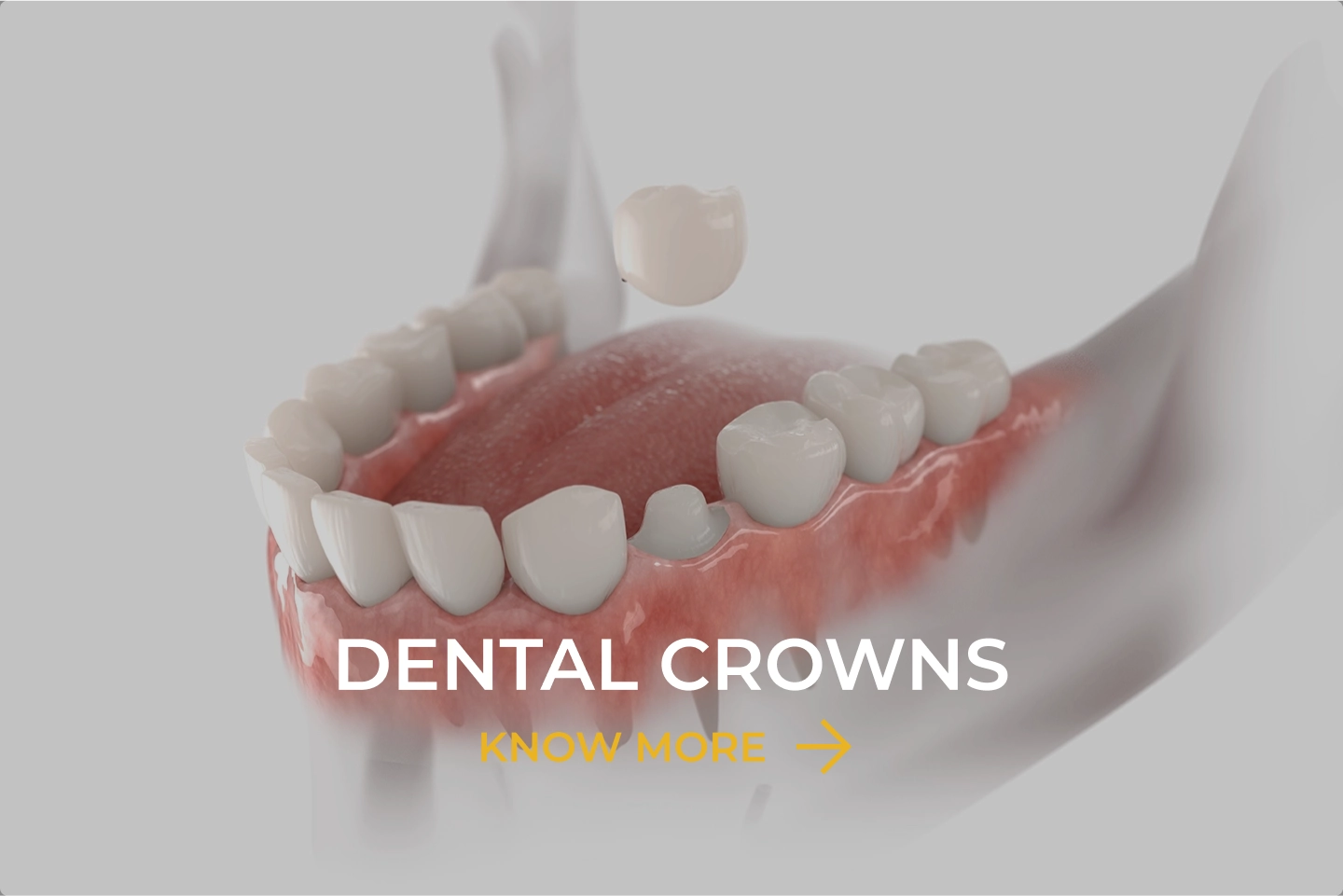 Dental Crowns