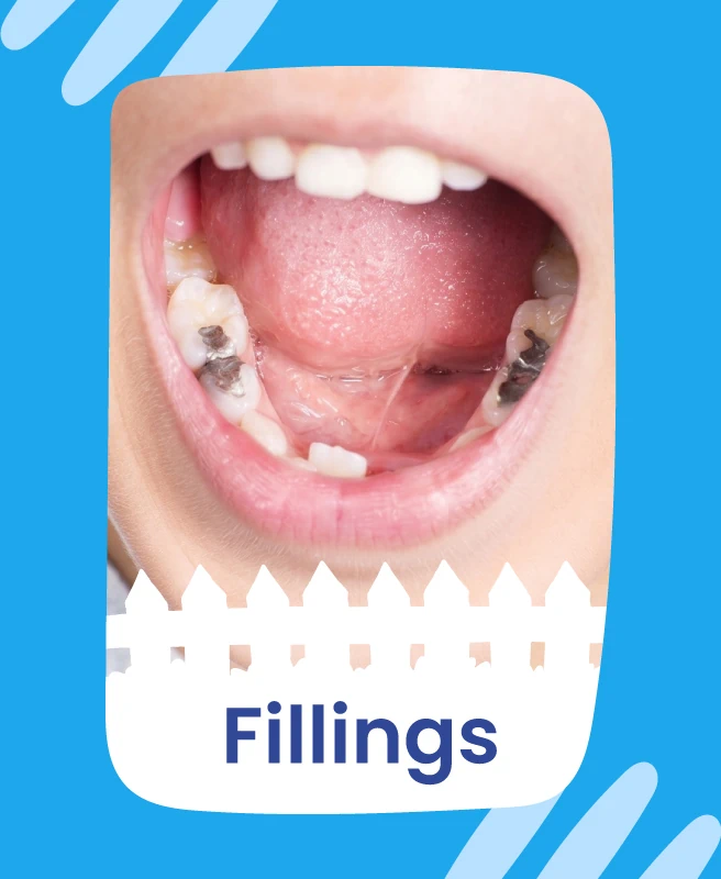 fillings