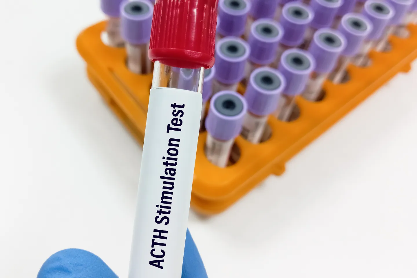 Adrenocorticotropin Stimulation Tests (ACTH)