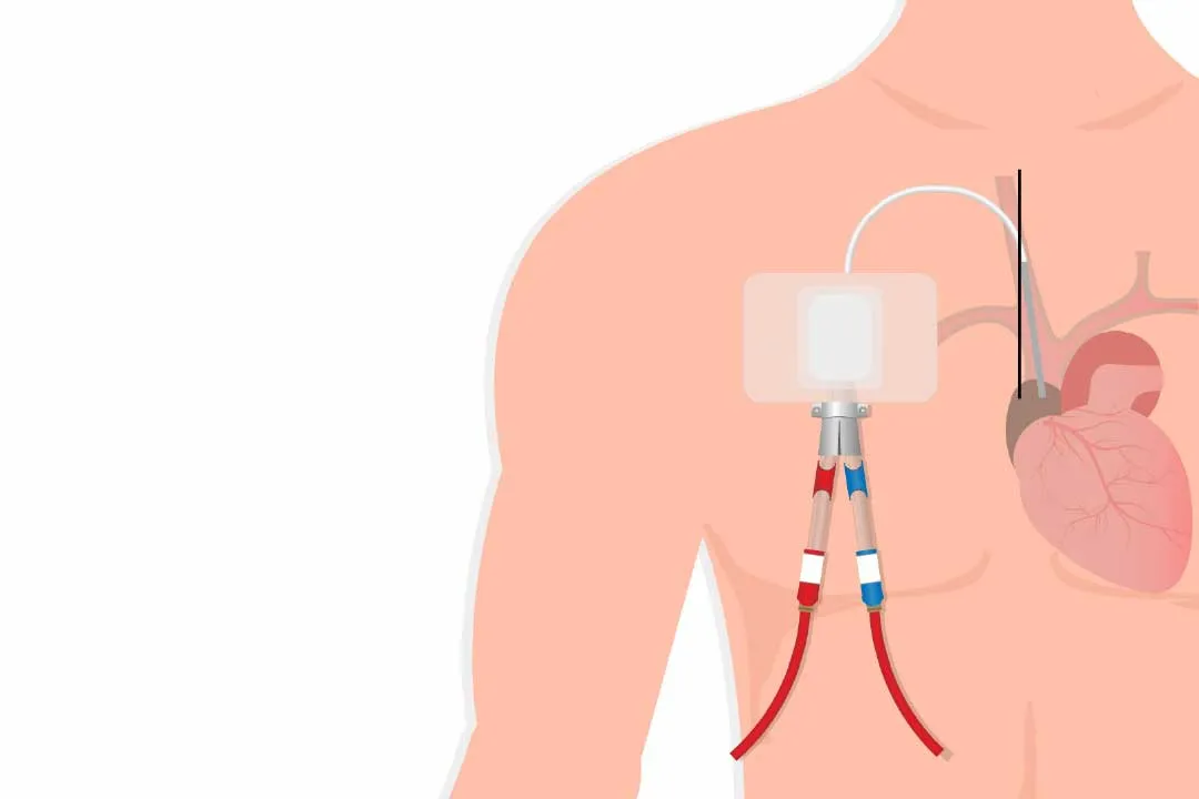 Dialysis Access Procedures