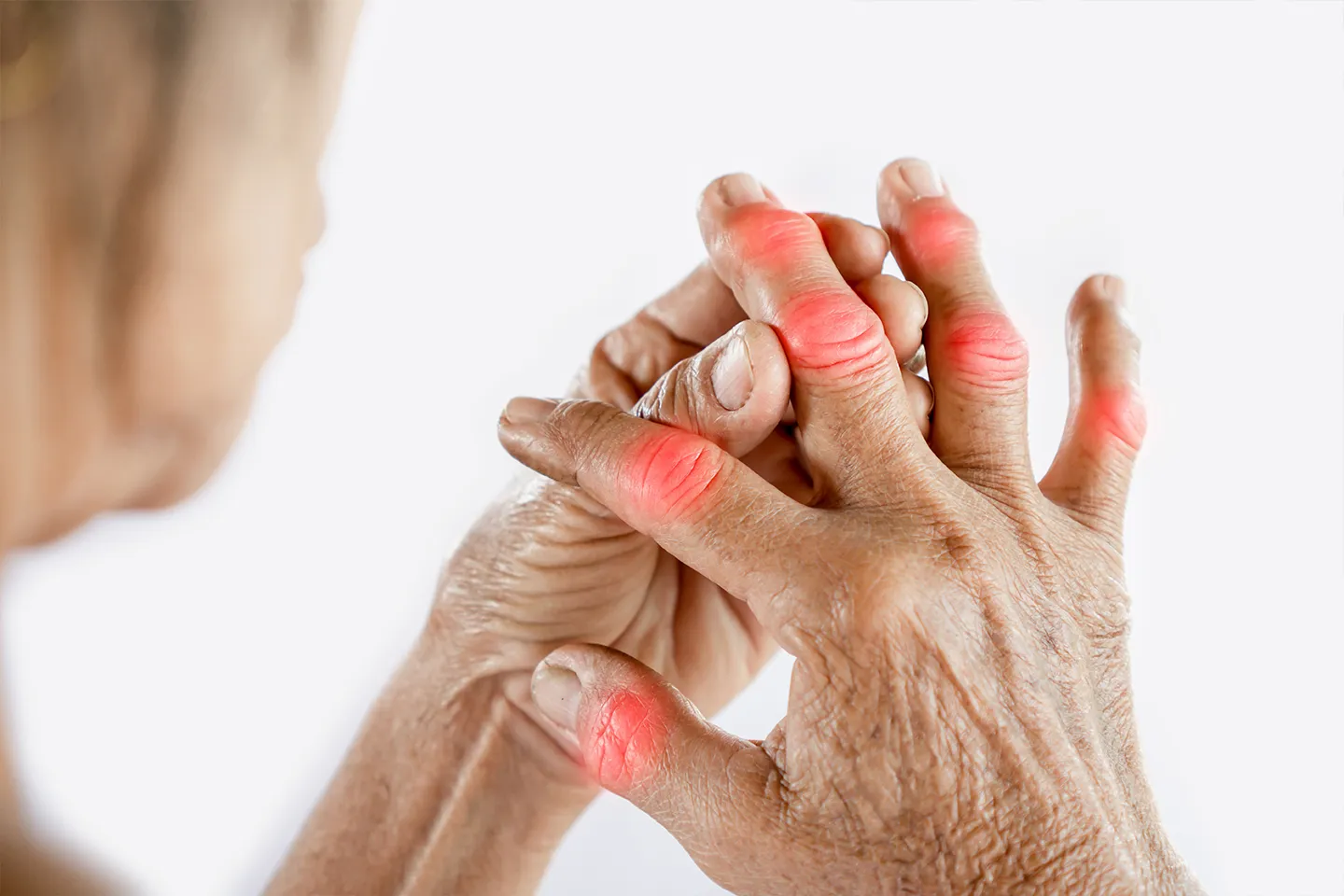 Arthritis (Osteoarthritis & Rheumatoid Arthritis)