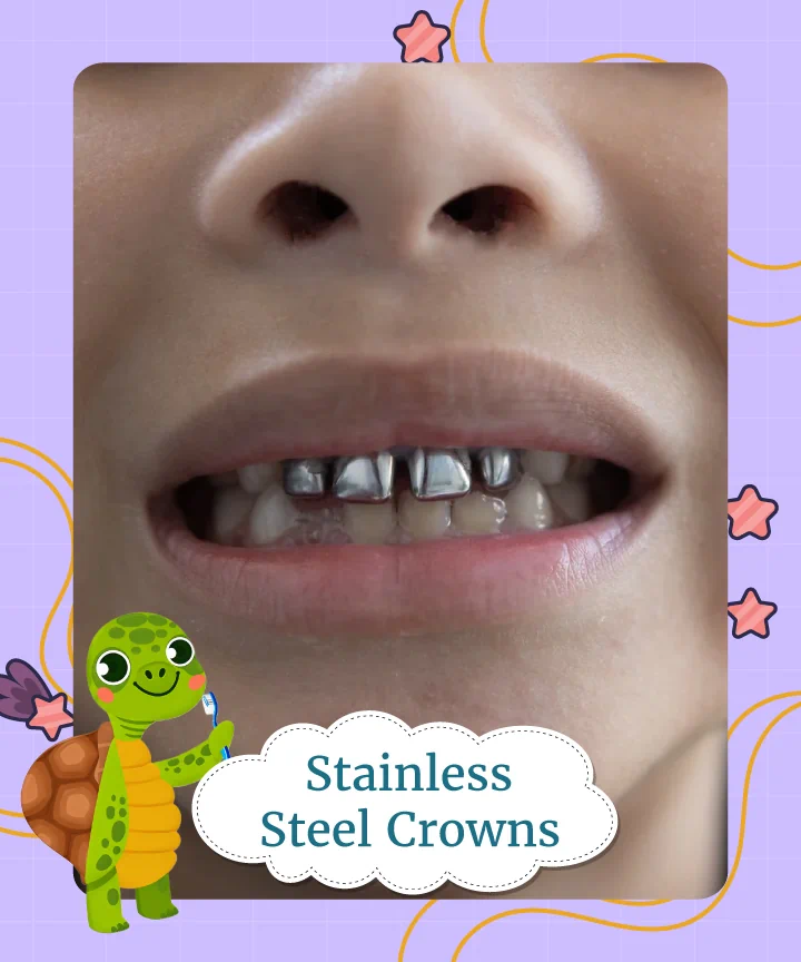 Stainless Steel Crowns
