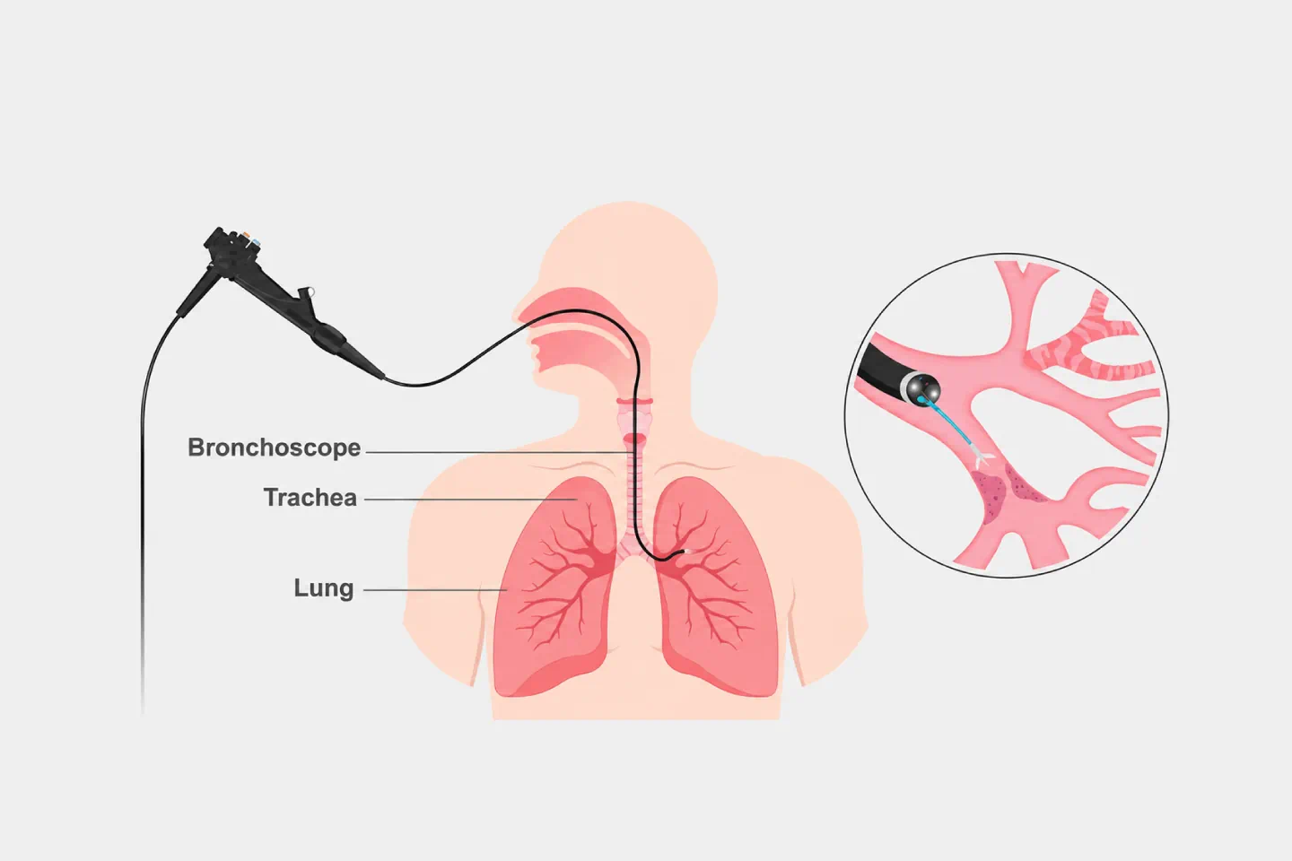 Bronchial Endoscopy