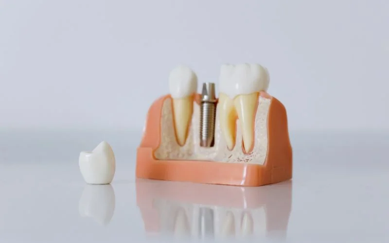 Signs Your Dental Implant Is Healing Properly!