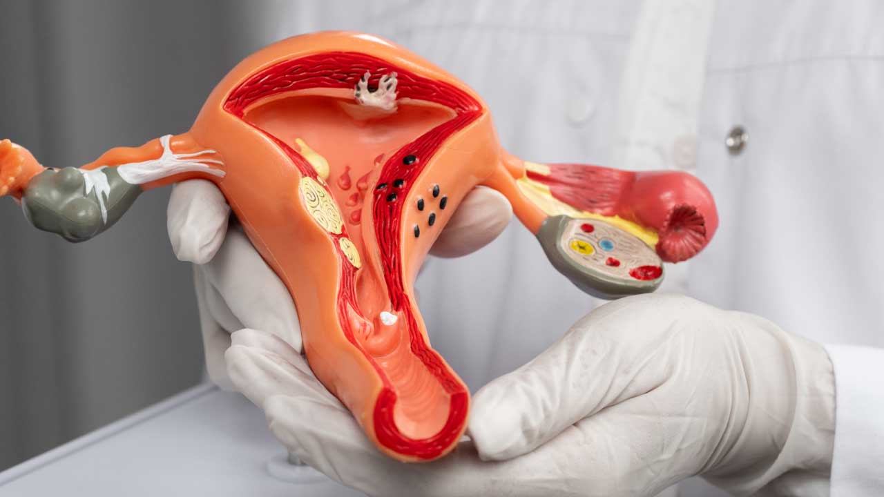 Endometrial Ablation: Understanding the Procedure and Recovery     