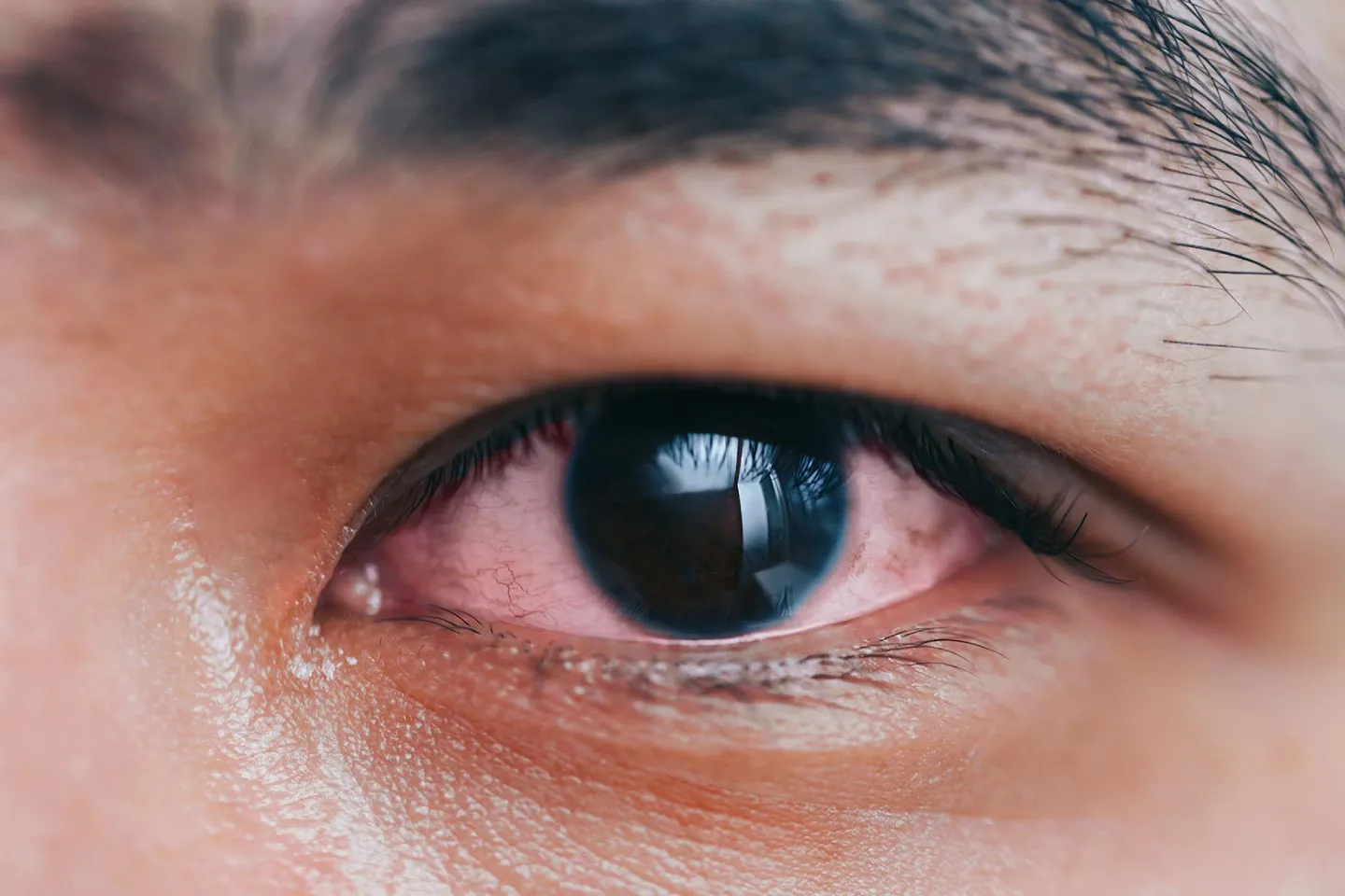 What You Should Know About Eye Herpes