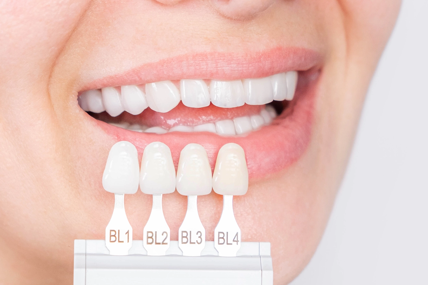 Porcelain Veneers