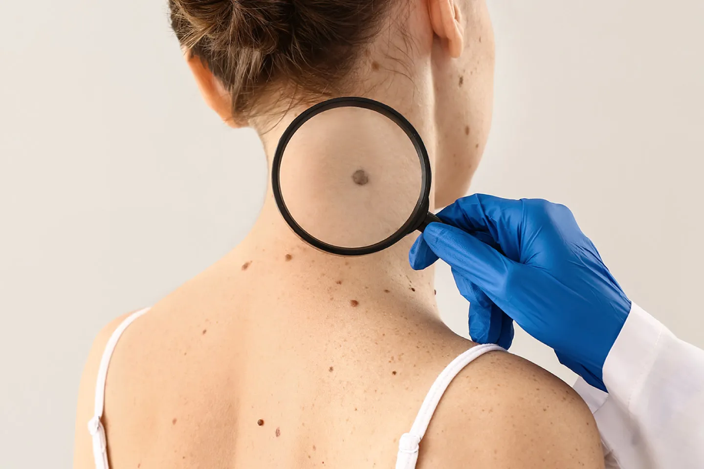 Patient suffer from malignant melanoma having moles on her body