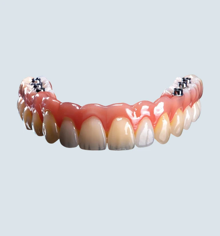 Implant supported dentures
