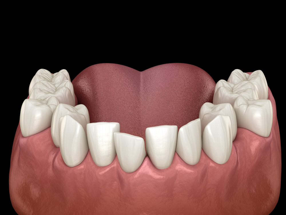 Teeth Misalignment