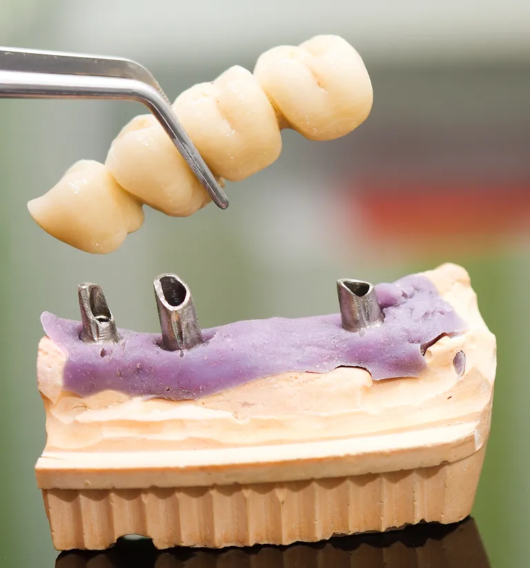 Dental Implants vs. Dentures and Bridges: Which Option Is Right for You?