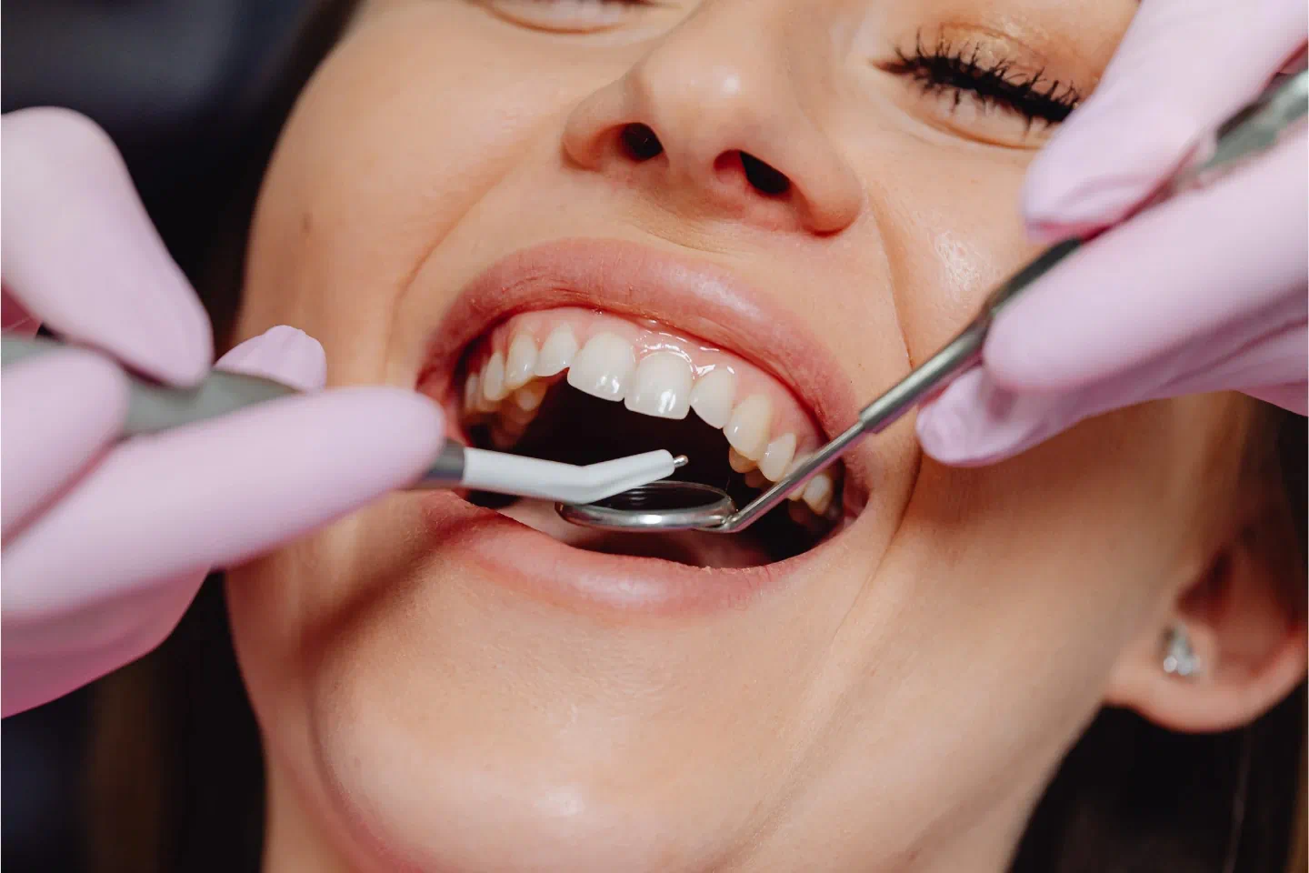 Gum Surgery