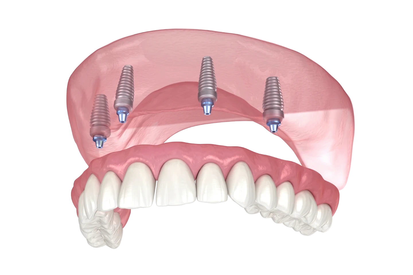 Snap on dentures