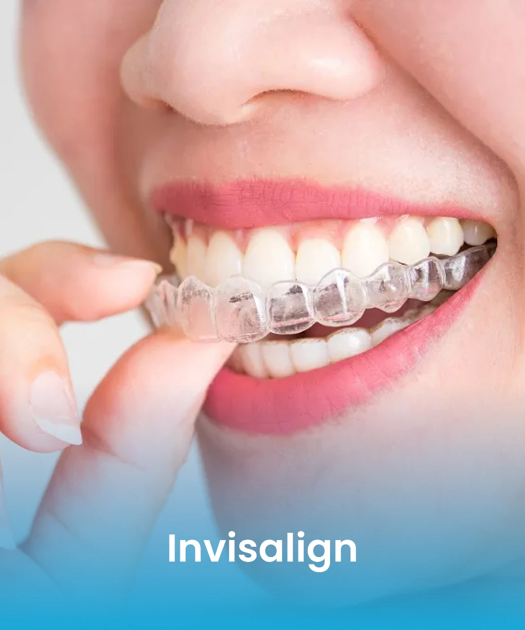 Patient wearing Invisalign clear aligners
