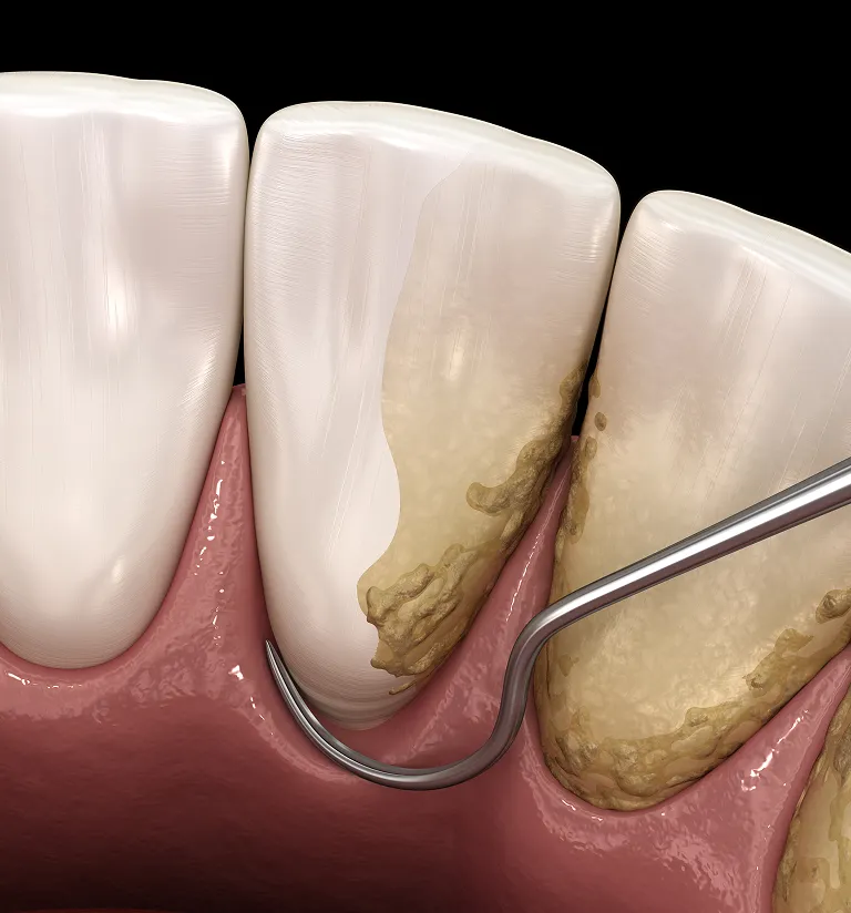 Implant Supported Dentures Model