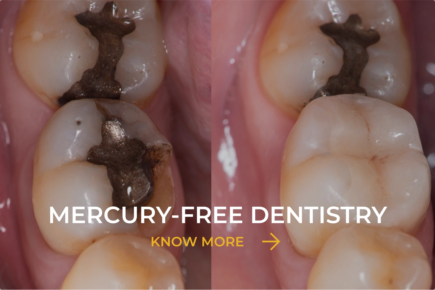 Mercury-free dentistry