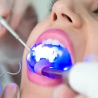 Dental Treatment in UK Vs Abroad – Why UK is best?