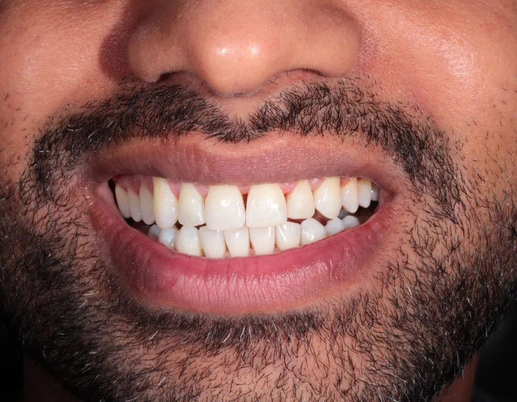 Invisalign