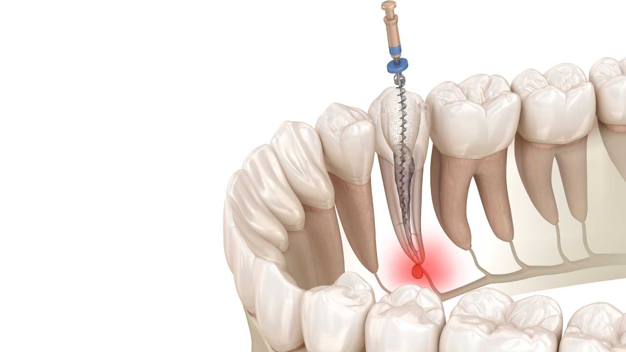 Root Canal Therapy What You Need to Know