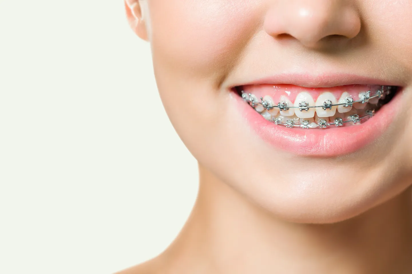 Braces