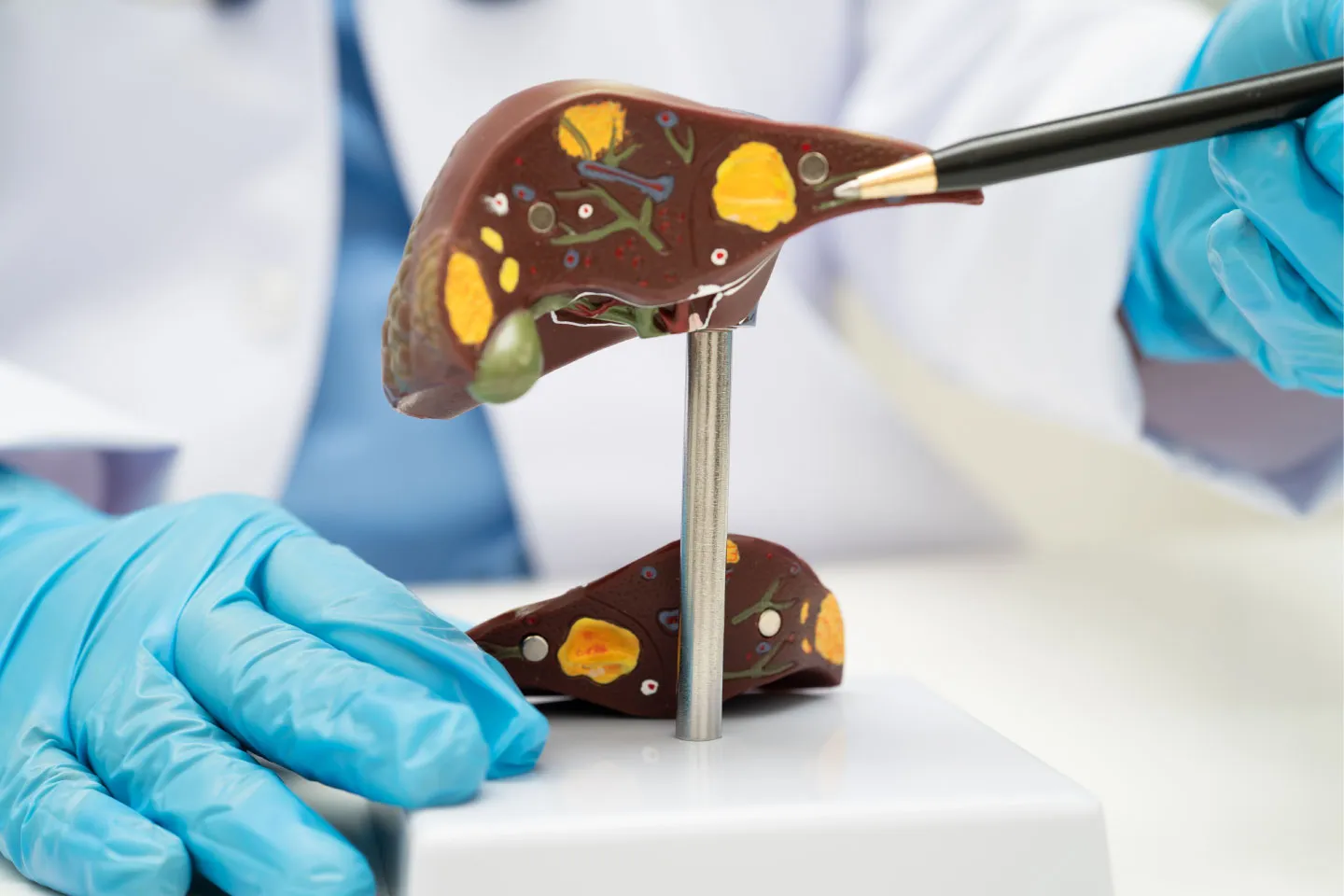 Liver Transplantation