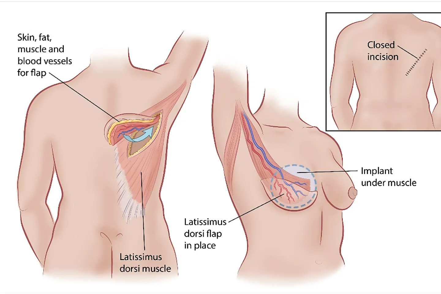 Latissimus Dorsi Flap Reconstruction