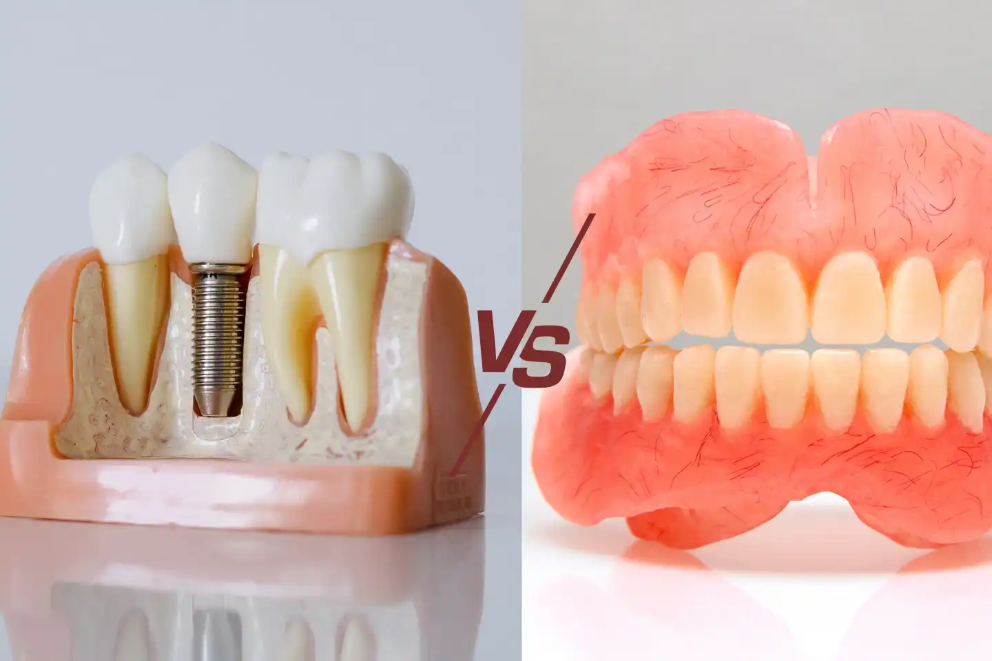 Dental Implants vs Dentures in Manteca, CA
