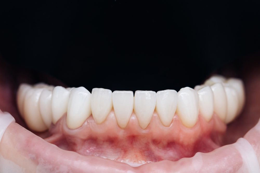 Porcelain vs. Composite Veneers
