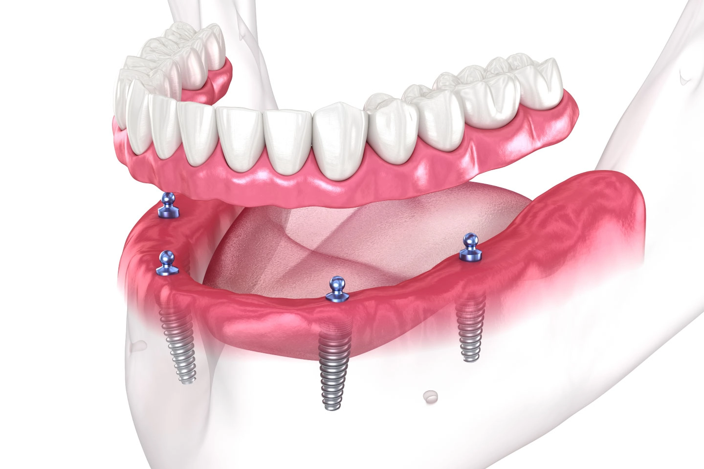 Full Mouth Reconstruction Great Smile Dental, Marietta GA