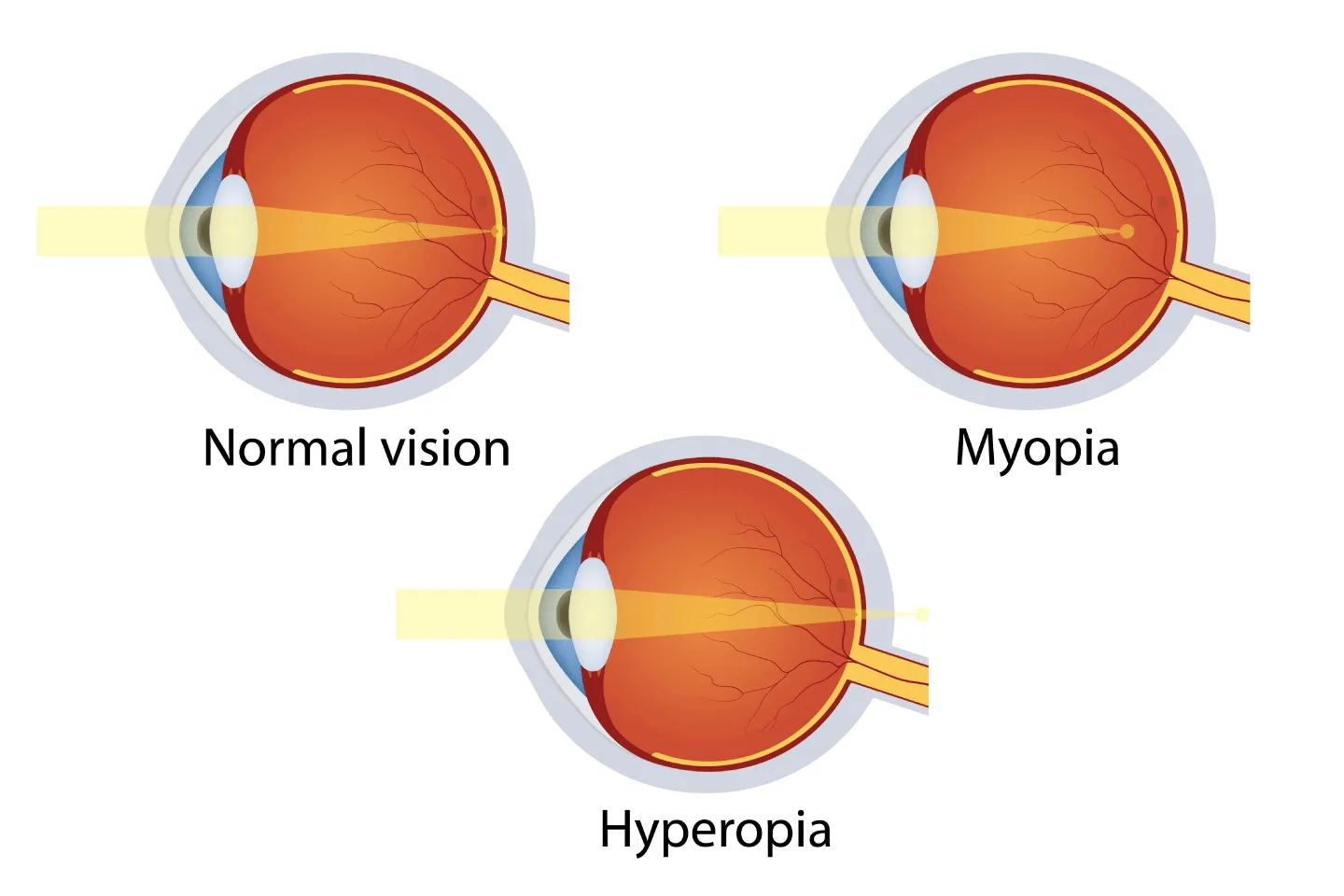 How Does High Myopia Affect Eye Health